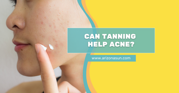 Can Tanning Help Acne?