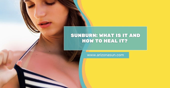 Sunburn: What Is It and How to Heal It?
